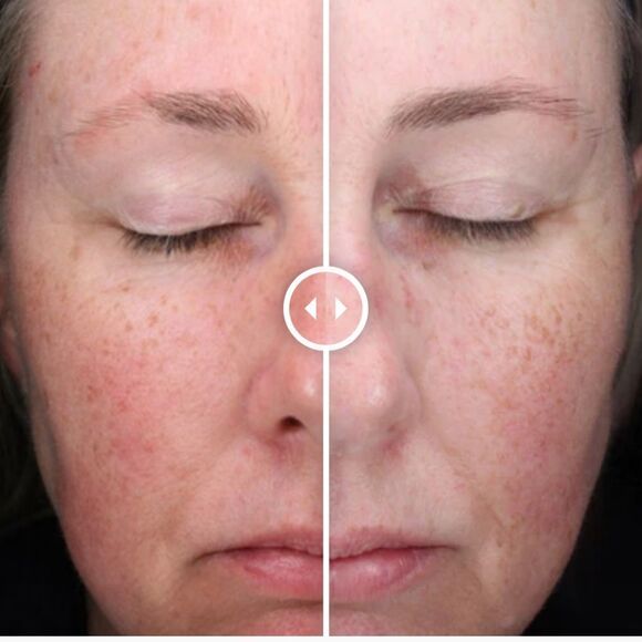 Alastin C Radical Defense Antioxidant Serum for redness, uneven texture & lines - Picture 6 of 7